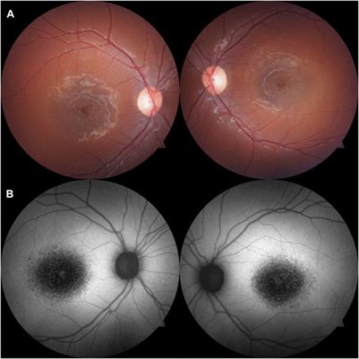 Case report: Disease phenotype associated with simultaneous biallelic mutations in ABCA4 and USH2A due to uniparental disomy of chromosome 1